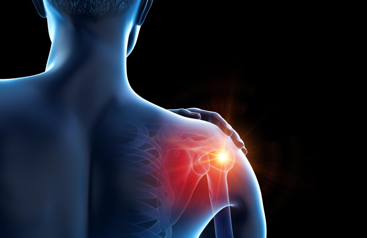 Shoulder Impingement: Quick Relief & Long-Term Fixes from Gurgaon’s Sports Ortho Expert 1 303561