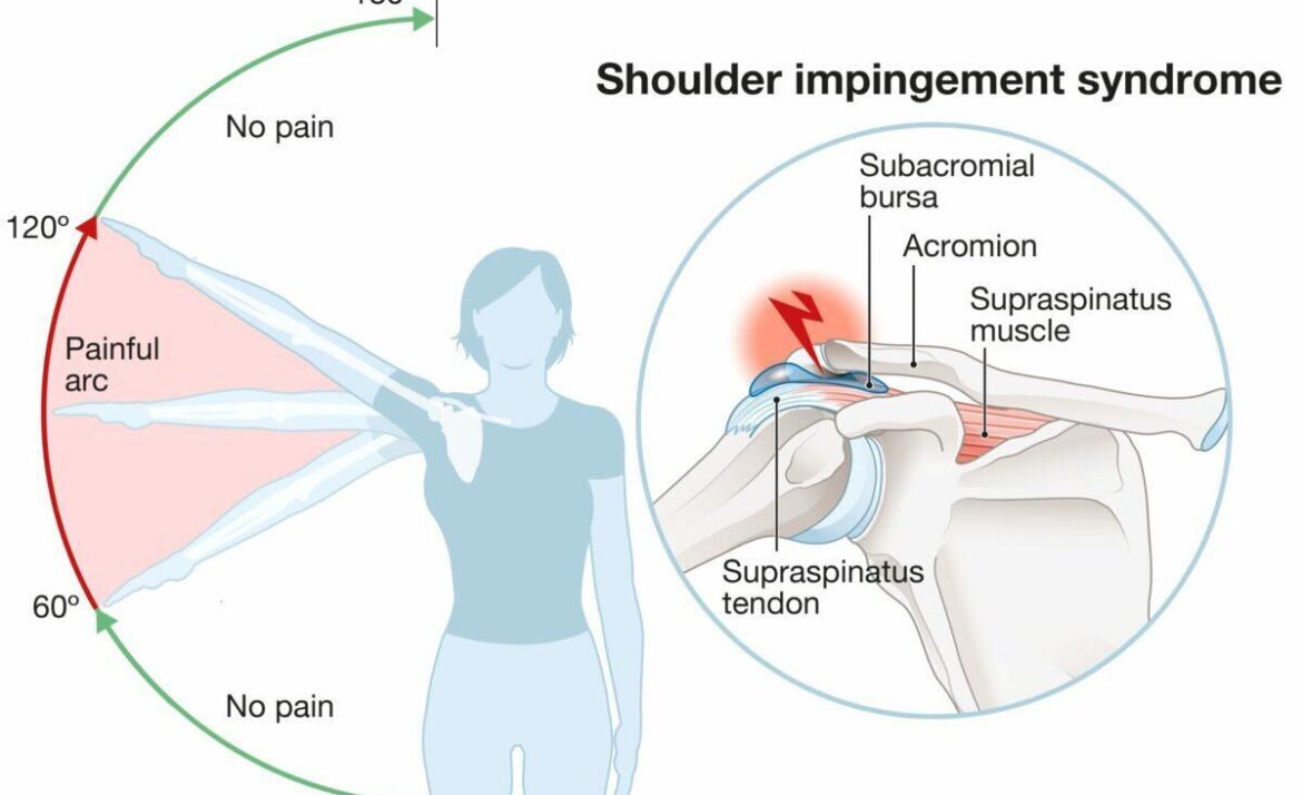Shoulder Impingement: Quick Relief & Long-Term Fixes from Gurgaon’s Sports Ortho Expert 2 Dr Sachin, orthopedic doctor treating shoulder impingement in Gurgaon clinic.